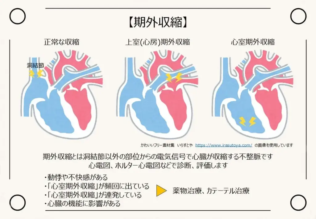 期外収縮